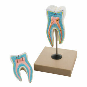 Eisco AM0046 - Upper Triple Root Molar with Caries Model- 2 Parts ...